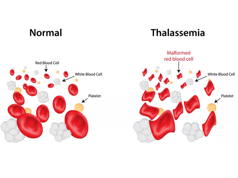 Ilustrasi penyakit Thalasemia.